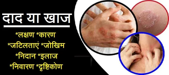 दाद: लक्षण, कारण, जटिलताएं, जोखिम, निदान और इलाज
