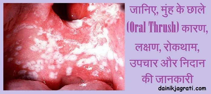 मुंह में छाले