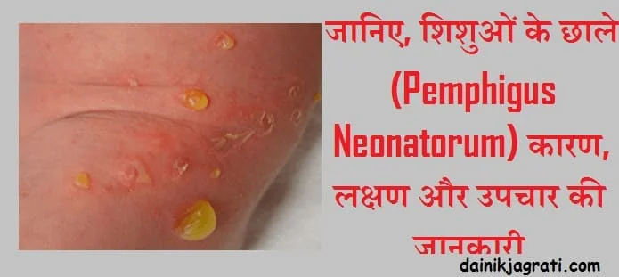 शिशुओं के छाले