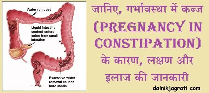 गर्भावस्था में कब्ज