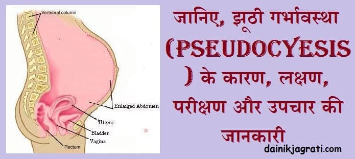 झूठी गर्भावस्था