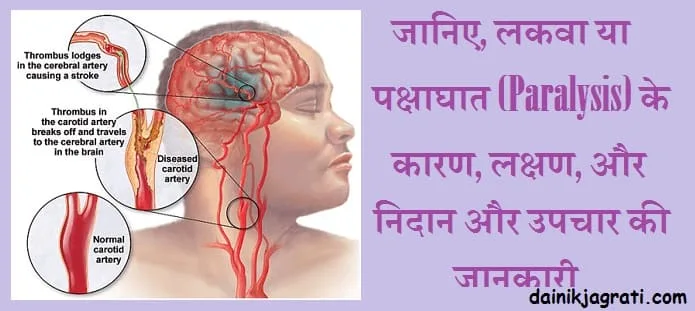 लकवा (पक्षाघात)