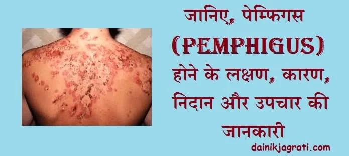 पेम्फिगस