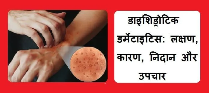 डाइशिड्रॉटिक डर्मेटाइटिस