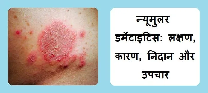 न्यूमुलर डर्मेटाइटिस: लक्षण, कारण, जोखिम, डाइट, निदान और इलाज