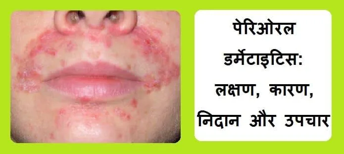 पेरिओरल डर्मेटाइटिस: लक्षण, कारण, जोखिम, निदान और इलाज