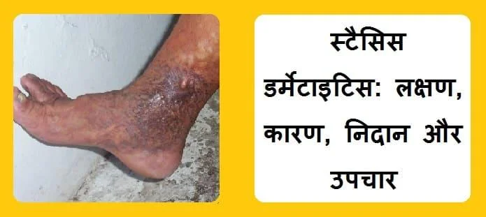 स्टैसिस डर्मेटाइटिस: लक्षण, कारण, जोखिम, जटिलताएं, निदान, इलाज